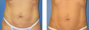 Exilis Ultra 360™ Before and After Photo Gallery