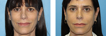 Juvéderm Voluma® XC Before and After Photo Gallery