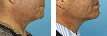 Kybella® Before and After Photo Gallery