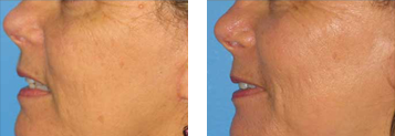 Laser Skin Resurfacing Before and After Photo Gallery