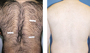 Hair Removal Photo Gallery - Boston, MA