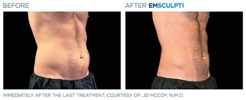 EMsculpt Neo Before and After