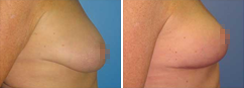 Before and After Breast Aug