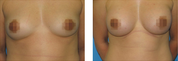 Breast Augmentation Photo Gallery - Boston, MA