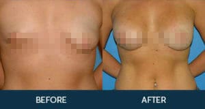 Breast Asymmetry Correction Gallery