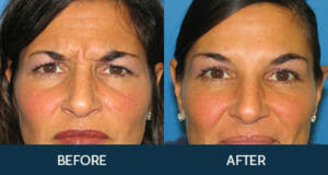 BOTOX® Cosmetic Gallery