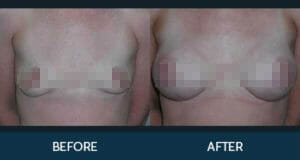 Breast Augmentation Gallery