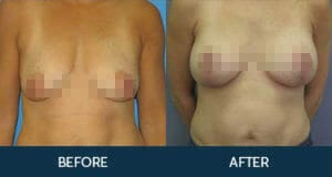 Breast Augmentation with Lift Gallery
