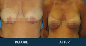 Breast Augmentation with Lift Gallery