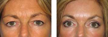 BOTOX® Cosmetic Before and After Photo Gallery