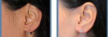 Earlobe Repair Before and After Photo Gallery - Boston, MA