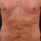 Non Surgical Muscle Toning and Body Contouring Boston