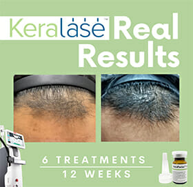 KeraLase, Laser Hair Growth Treatment Before and After Boston, 