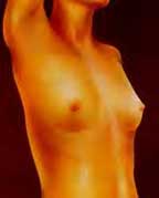 Breast Aug Example 1