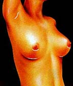 Breast Aug Example 4
