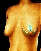 Breast Lift Example