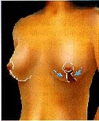 Breast Lift Example 2