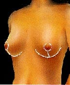 Breast Lift Example 3