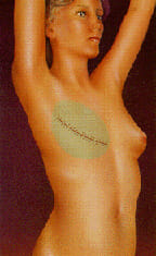 Breast Reconstruction Option 1 Example
