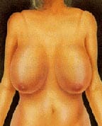 Breast Reduction Example