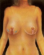Breast Reduction Example 3