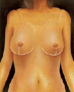 Breast Reduction Example 4