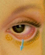 Eyelid surgery example 5