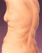 Liposuction Example 4