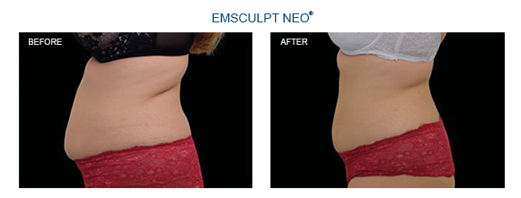 EMsculpt Neo Before and After Results Photo