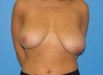 Breast Asymmetry Correction Before - Boston, MA
