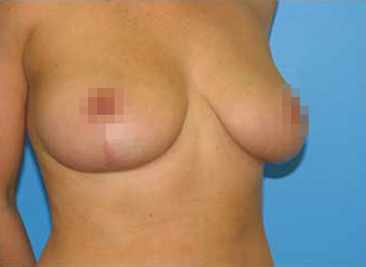 Breast Asymmetry Correction After - Boston, MA
