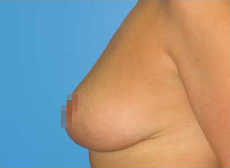 Breast Asymmetry Correction After - Boston, MA