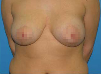 Breast Asymmetry Correction After - Boston, MA=