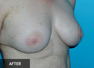 Breast Augmentation After - Boston, MA