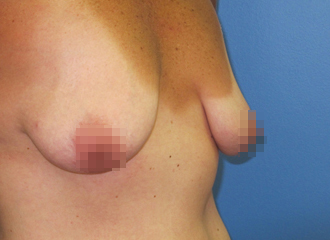 Breast Augmentation Before - Boston, MA