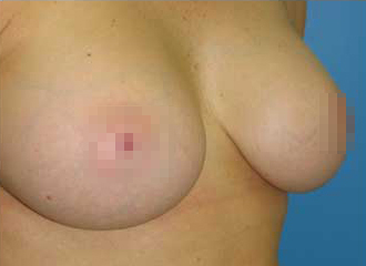 Breast Augmentation After - Boston, MA=