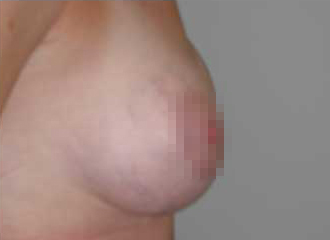 Breast Augmentation After - Boston, MA=