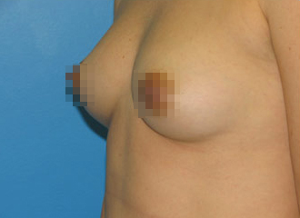 Breast Augmentation Before - Boston, MA