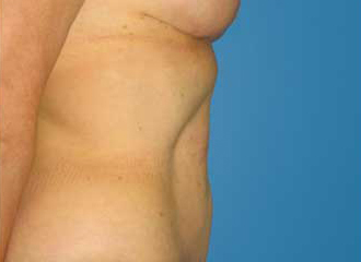 Tummy Tuck (Abdominoplasty) After - Boston, MA