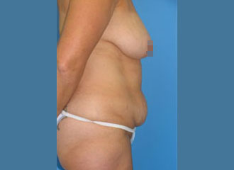 Tummy Tuck (Abdominoplasty) Before - Boston, MA