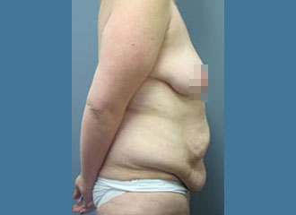 Tummy Tuck (Abdominoplasty) Before - Boston, MA